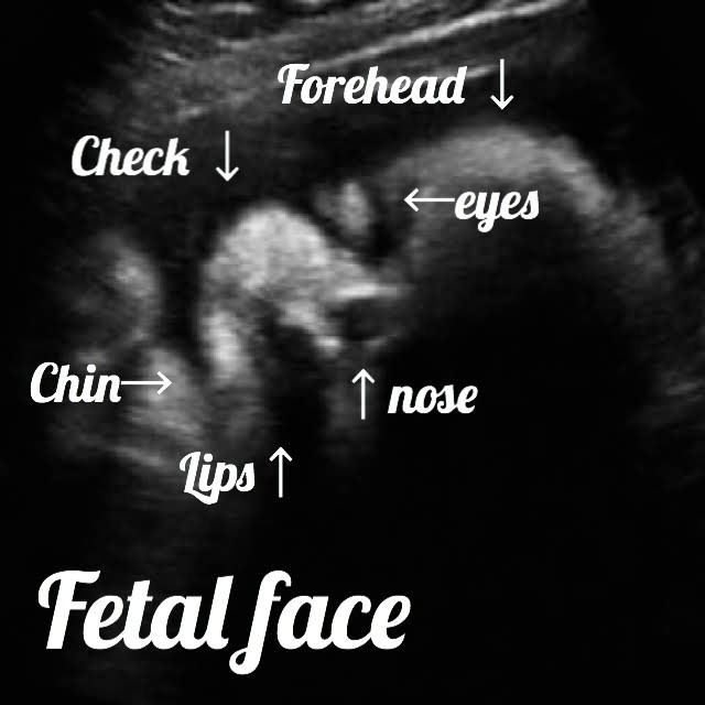 ultrasound image at 32 weeks, showing the normla fetal face in 2d