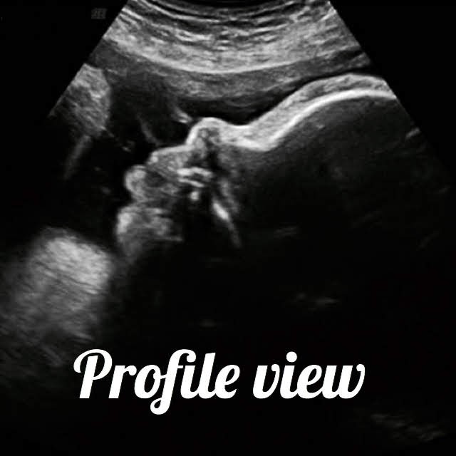 profile image of a baby seen on ultrasound