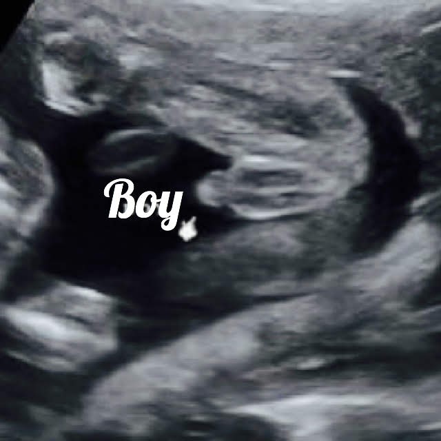 boy gender as seen on ultrasound
