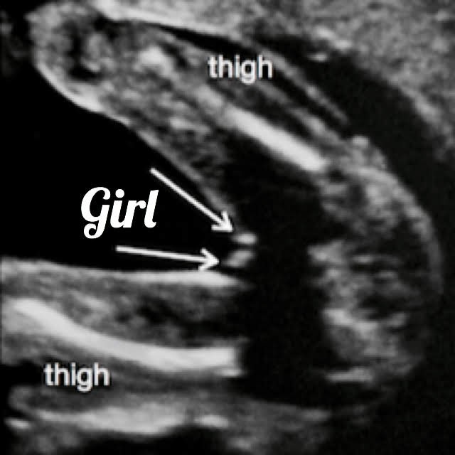 ultrasound image showing a girl gender