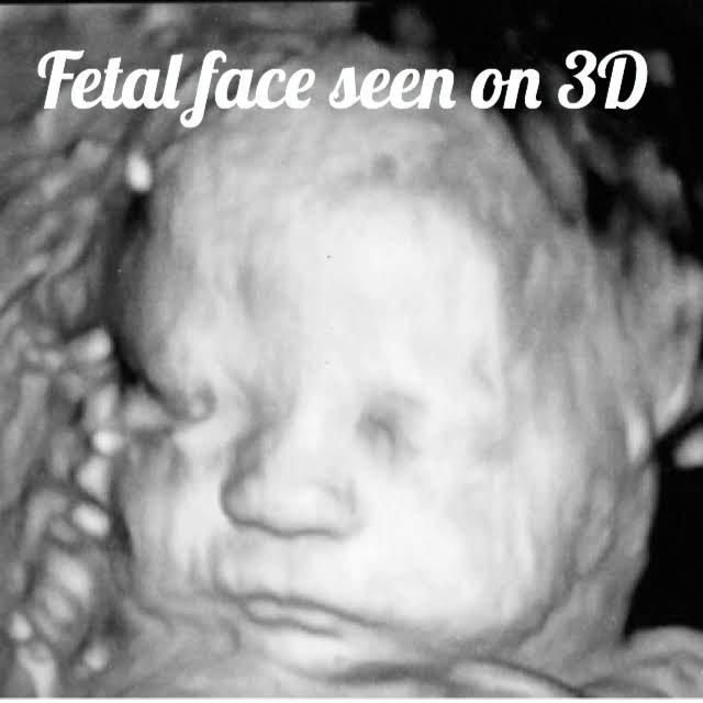 3D ultrasound image of a baby's face
