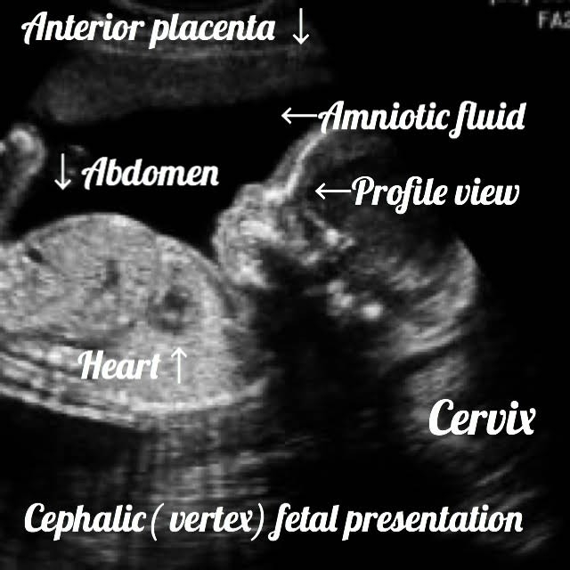 ultrasound image of a 32 week baby