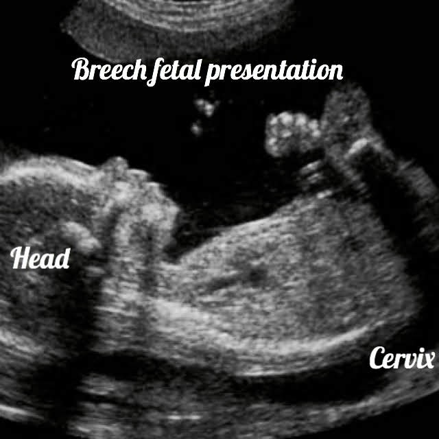 ultrasound image of a baby at 32 weeks
