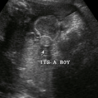 ultrasound image showing the boy gender