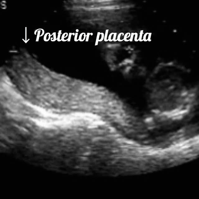 ultrasound image of a baby at 32 weeks, showing the normal posterior placents