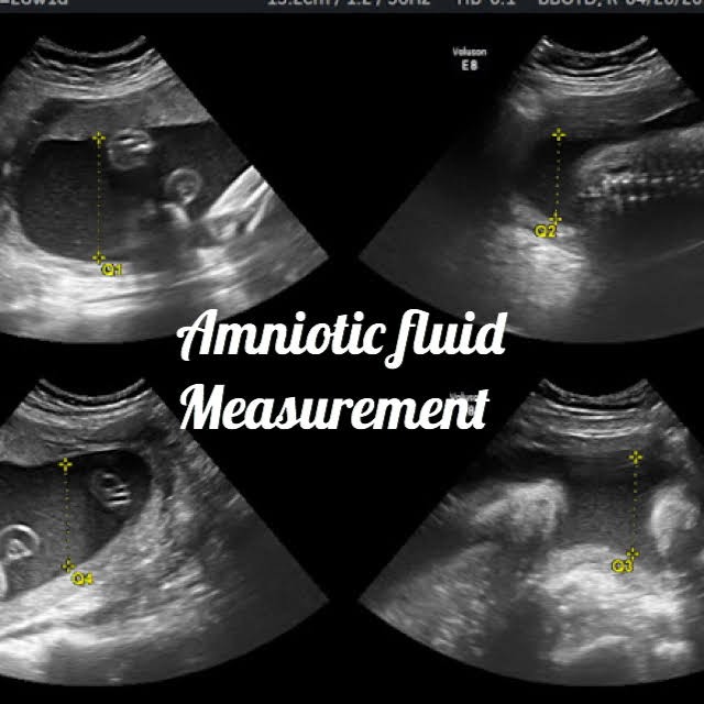 ultrasound image of a baby at 32 weeks, showing the normal amniotic fluid measurements