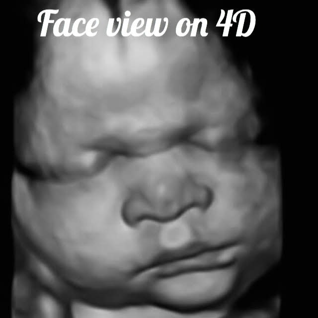 ultrasound image of a baby at 32 weeks, showing the normal babys face