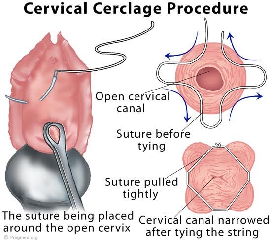 illustration of cerclage for cervical incompetence