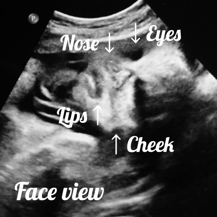 baby ultrasound at 33 weeks