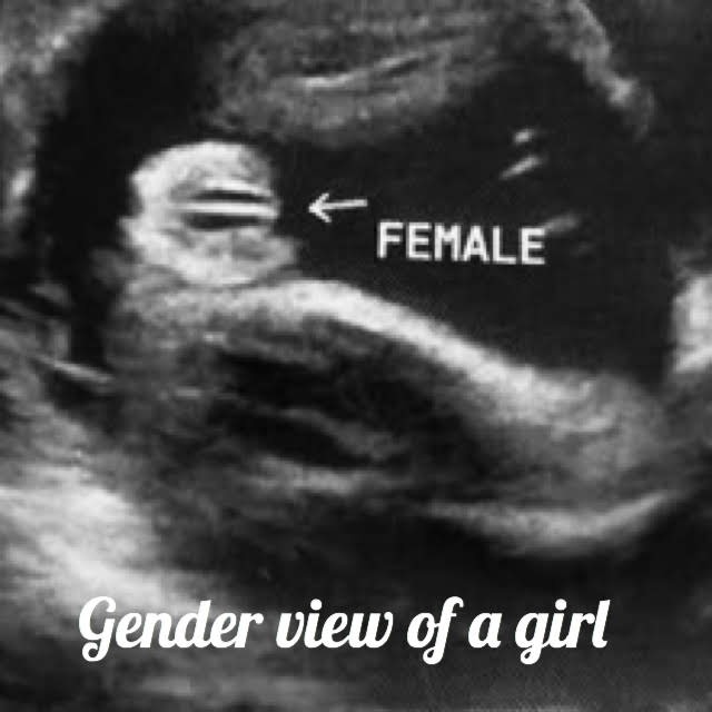 female gender seen on ultrasound