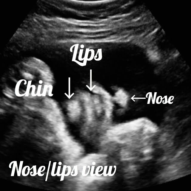 34 week pregnancy and ultrasound
