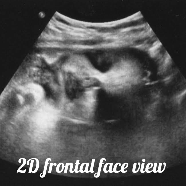 34 week pregnancy and ultrasound