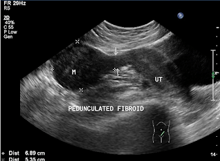 Anteverted Uterus / Pedunculated Fibroid / Transabdominal scan.