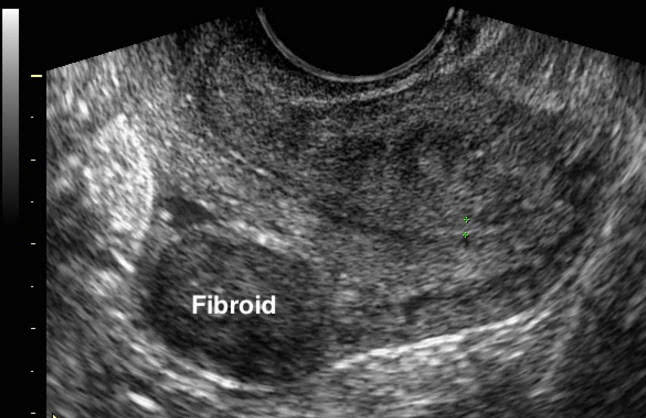 Retroverted Uterus / Subserosal Fibroid / Transvaginal scan.