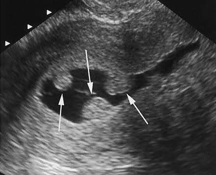endometrial polyps seen within the cavity through a sonohystogram