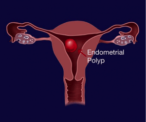 Endometrial polyp