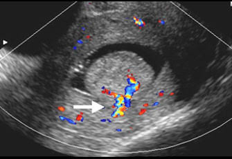 polyp seen within uterine cavity