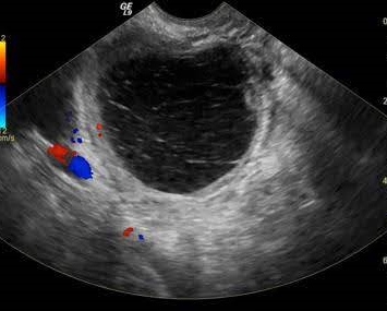 Ultrasound image of a Hemorrhagic cyst.