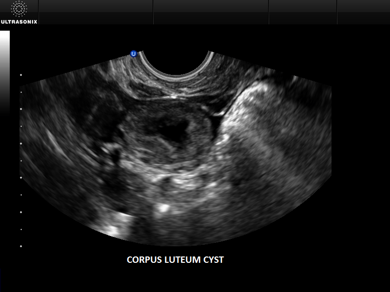 Ultrasound image of Corpus luteal cyst.
