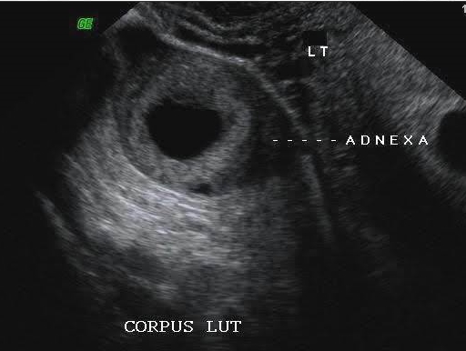 Ultrasound image of a corpus luteum