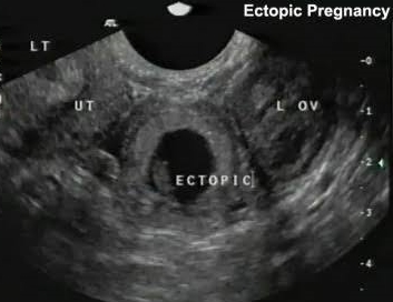 ectopic pregnancy seen on ultrasound