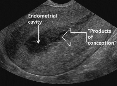 early gestation ultrasound