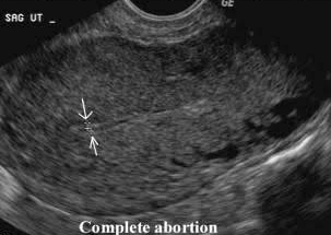 early gestation ultrasound