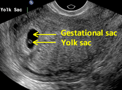 ultrasound image of a gestatonal sac and yolk sac within the uterus, early pregnancy