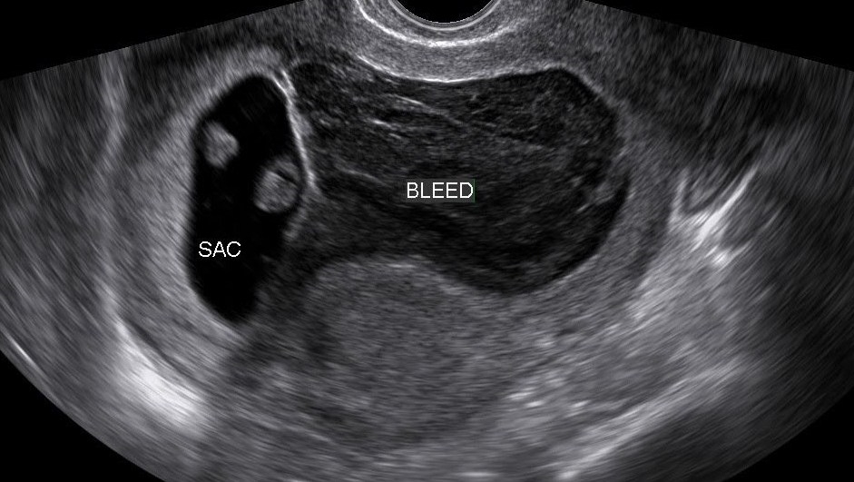 Normal First Trimester 6 Weeks Ultrasound Ultrasoundfeminsider