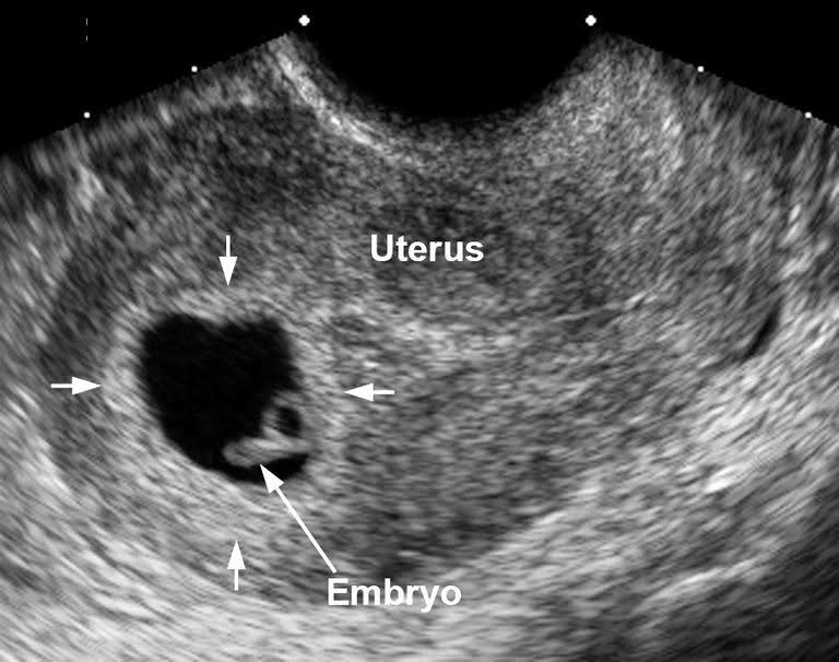 Normal First Trimester 6 Weeks Ultrasound Ultrasoundfeminsider 