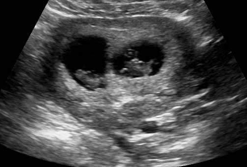 6 weeks ultrasound