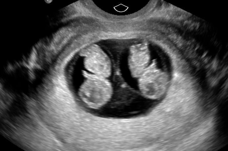 6 weeks ultrasound