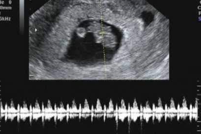 9 weeks baby ultrasound