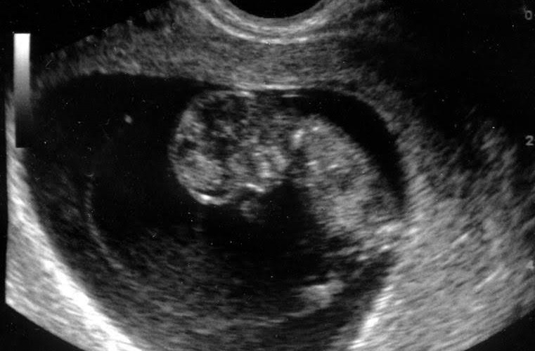 10 weeks baby ultrasound