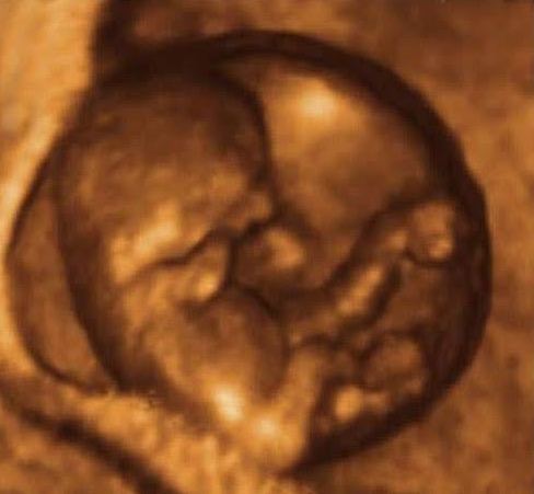10 weeks baby ultrasound