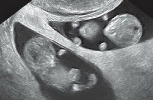 10 weeks baby ultrasound, TWINS