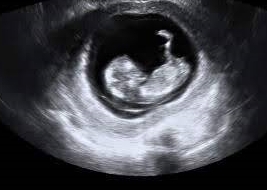This is how your 11 weeks baby ultrasound should look like.