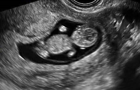 11 weeks baby ultrasound