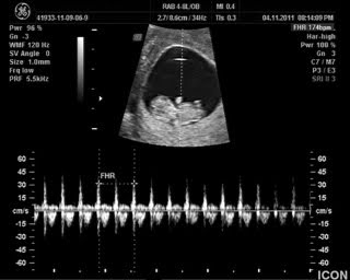 normal 12 week ultrasound.