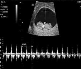 11 weeks baby ultrasound, HEART DOPPLER