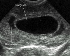 Anembryonic pregnancy ( Blighted ovum), dignosis confirmed with an ultrasound