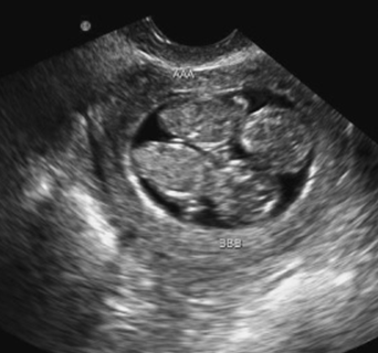twin pregnancy ultrasound