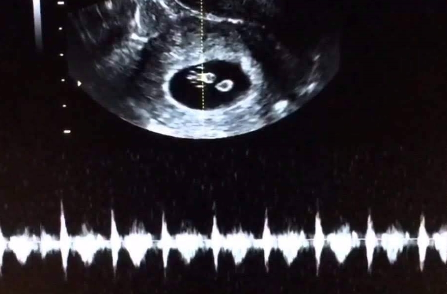 Normal 7 week ultrasound