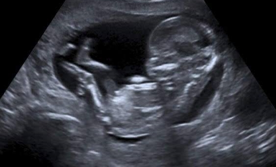 At 13 weeks ultrasound 13 Weeks