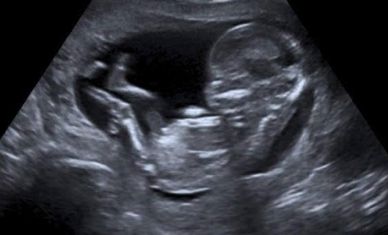 13 weeks, fetal body seen on ultrasound