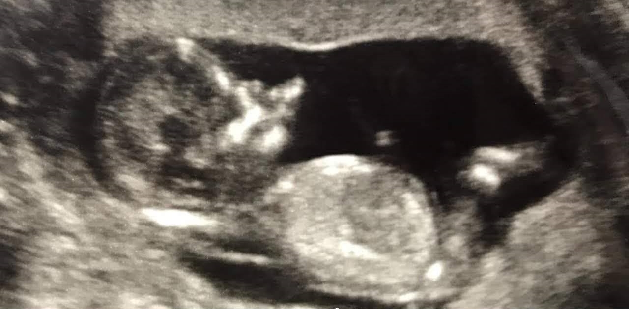 13 week baby ultrasound