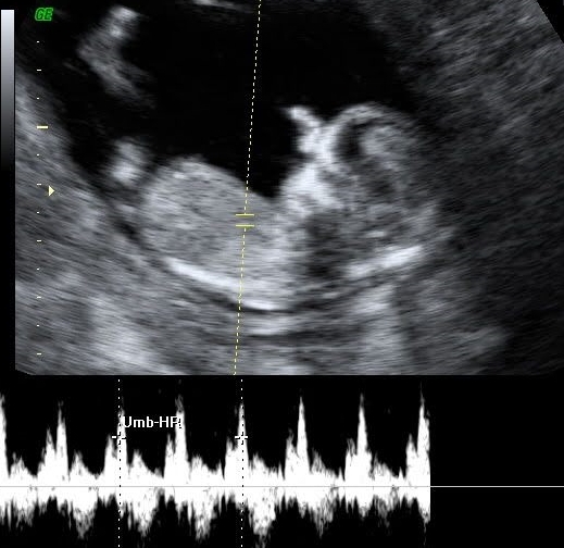 heart doppler at 13 weeks