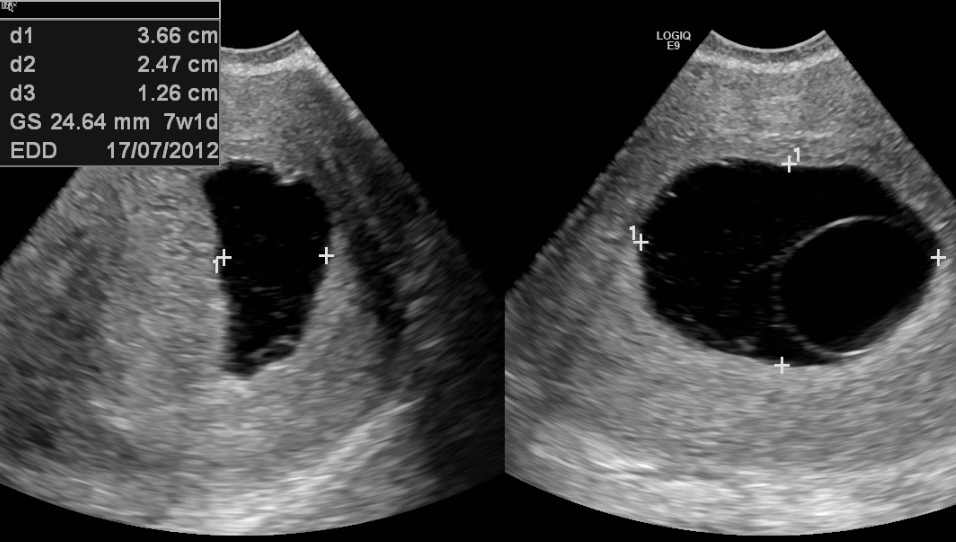 anembrionic pregnancy ultrasound image