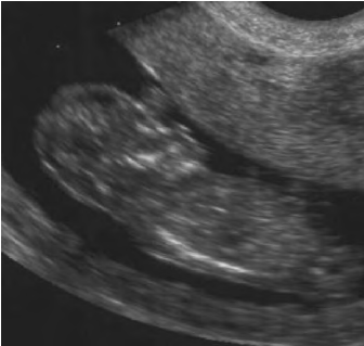 acrania ultrasound image