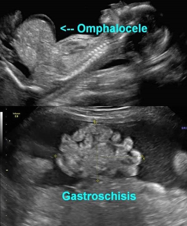 gastroschysis and omphalocele